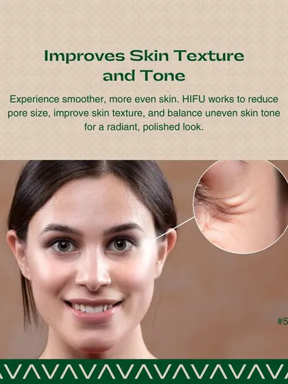 Beyond lifting, HIFU also improves overall skin texture and tone. The treatment helps reduce pore size and balances uneven tone, resulting in a smoother, more polished look.