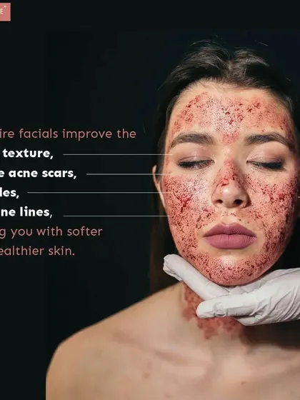 A closer look at the benefits of a Vampire Facial. It is excellent for improving overall skin texture, reducing fine lines, and is particularly effective for treating atrophic acne scars by promoting natural skin regeneration.