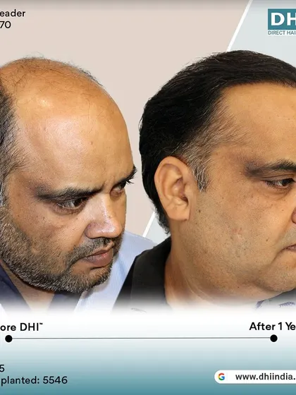 A before and after of a 45-year-old client one year after his procedure. With 5,546 hairs implanted, his scalp is now fully covered with dense, natural-looking hair.