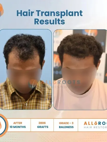 This 10-month result for a Grade 3 baldness case, using 2806 grafts, showcases a significant improvement in density and a perfectly restored hairline from all angles.