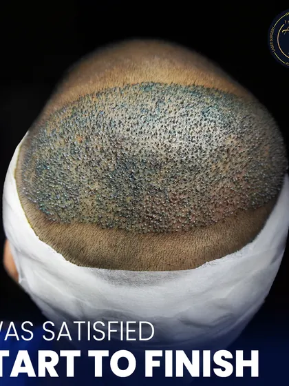 This is where science meets style. A detailed view of newly implanted hair follicles, showcasing the meticulous process of high-density hair restoration.