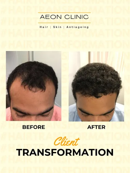 A clear look at a client's transformation. Our focus is always on creating dense, natural-looking results that blend seamlessly with your existing hair.