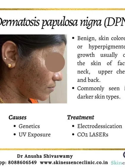 This graphic provides key information about Dermatosis Papulosa Nigra (DPN). It explains that these are benign growths common in darker skin types and outlines the effective treatment options I offer, such as electrodesiccation and CO2 lasers, for cosmetic removal.