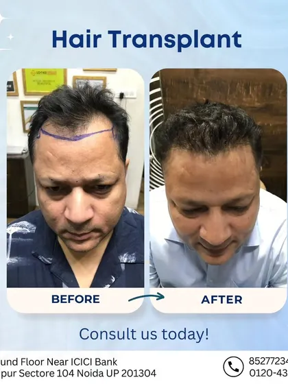 A clear view of a successful hair transplant result. Notice the restored hairline and the even density, which frames the face and provides a completely natural appearance.