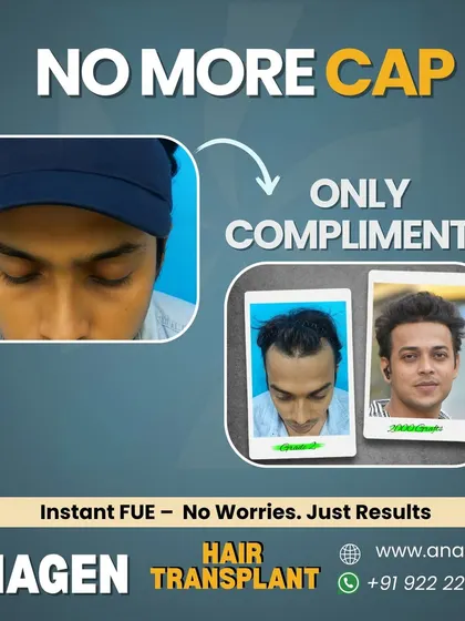 No more hiding under a cap. This before and after transformation is a testament to the confidence that a well executed hair transplant can bring back into your life.