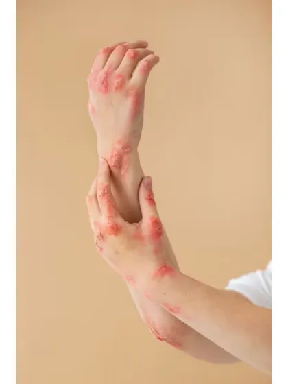 Autoimmune skin diseases like psoriasis or lupus require expert diagnosis and a carefully managed treatment plan. My approach focuses on controlling symptoms, reducing flare-ups, and improving your overall quality of life through medical therapies.