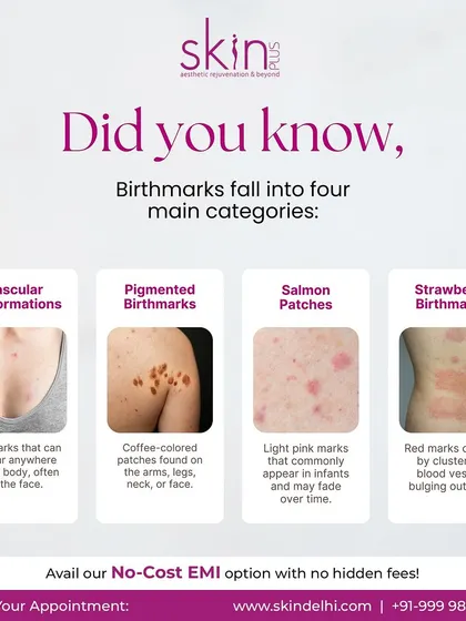 An educational graphic explaining the four main categories of birthmarks: Vascular Malformations, Pigmented Birthmarks, Salmon Patches, and Strawberry Birthmarks.