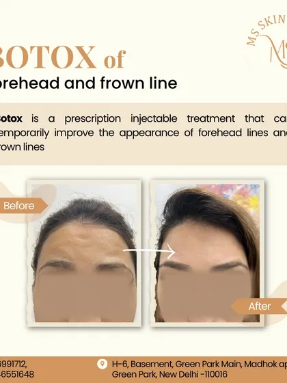 This is a powerful example of how I use Botox to smooth deep-set forehead and frown lines. The goal is always a natural, refreshed appearance, not a "frozen" look. This simple procedure can take years off your appearance and prevent lines from becoming permanently etched into the skin.