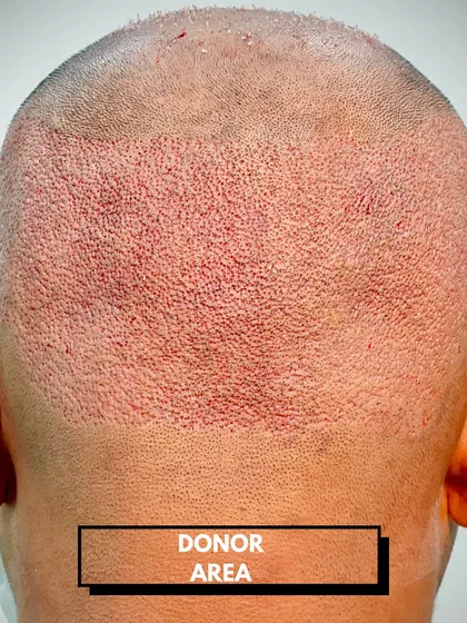 This is the donor area 10 days after a 4300-graft procedure. The area has healed well, demonstrating the minimal impact of the FUE technique on the back of the scalp.