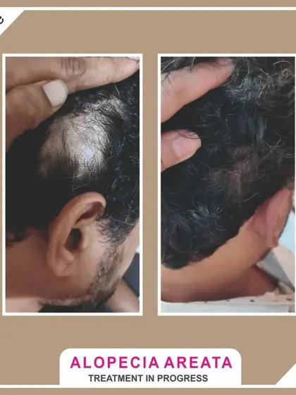 I offer targeted treatments for specific conditions like Alopecia Areata. This client is in the process of treatment for a bald patch, and you can already see the incredible progress in hair regrowth.