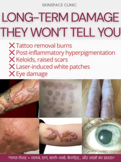 We believe in educating our clients about the serious risks of laser treatments done by untrained individuals. This image shows the potential for long-term damage, including burns, scars, and hyperpigmentation. Choosing a doctor-led clinic like ours is not just about results, it's about your safety.