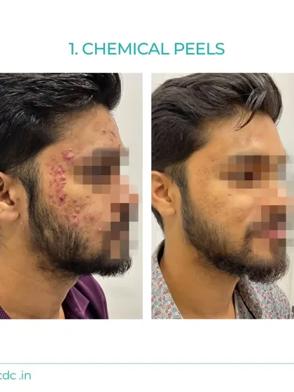 This before and after demonstrates the effectiveness of our customized chemical peel protocols for treating inflammatory acne. We create personalized plans to reduce breakouts and improve skin texture for long-term results.