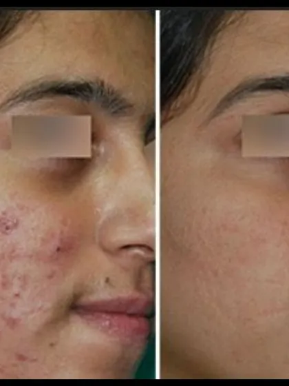 This before-and-after demonstrates the improvement in both acne lesions and the early stages of scarring. Early and consistent treatment is key to preventing permanent textural changes and achieving the best possible outcome.