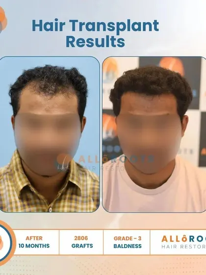 This 10-month result for a Grade 3 baldness case, using 2806 grafts, showcases a significant improvement in density and a perfectly restored hairline from all angles.