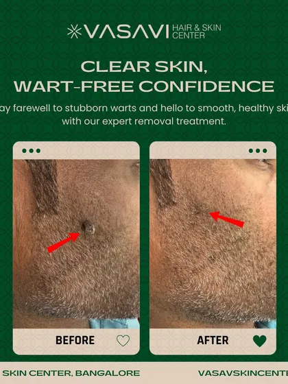 This demonstrates the precise removal of a facial wart from a patient's beard area. Treating facial growths requires careful technique to ensure complete removal and prevent scarring, which is my primary goal for all my patients.