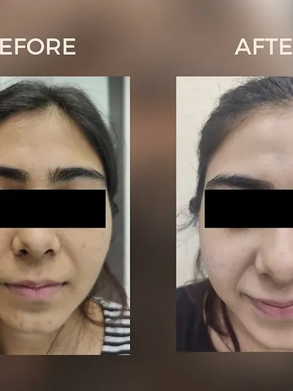 This before-and-after photo demonstrates the effectiveness of our Secret Microneedling RF treatment in improving skin texture and reducing the appearance of acne scars for a smoother complexion.