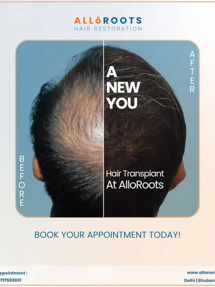 This image encapsulates the goal of my work: to give you a new beginning. The split view clearly shows the significant coverage achieved, turning back the clock on hair loss.