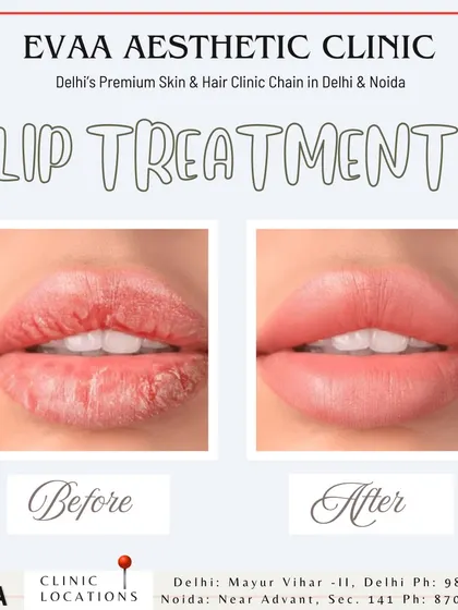 See the transformative power of our lip treatments. This before-and-after image displays how we can hydrate chapped lips and enhance their natural shape, resulting in a fuller, smoother, and more defined look.