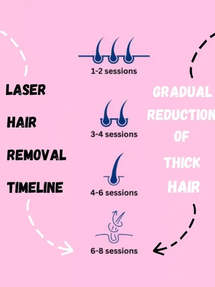 Laser hair reduction is a journey, not a one-time fix. This timeline shows you what to expect, from the gradual reduction of thick hair in the first few sessions to achieving up to 80% permanent reduction after a full course of 6 to 8 sessions.