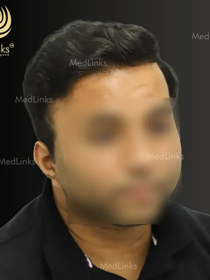 The final result from the side, showing a natural and full hairline.