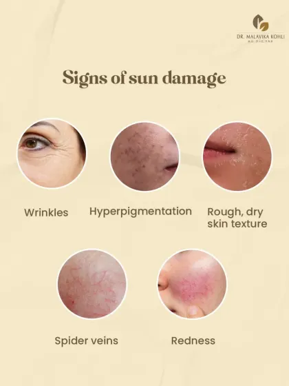 Sun damage can manifest in many ways beyond a simple sunburn. This graphic illustrates the hidden signs, including wrinkles, hyperpigmentation, rough texture, spider veins, and redness.