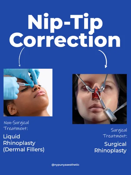 For nose tip correction, a non-surgical liquid rhinoplasty using dermal fillers can provide a subtle shape tweak. For a full structural change, a surgical rhinoplasty is required.