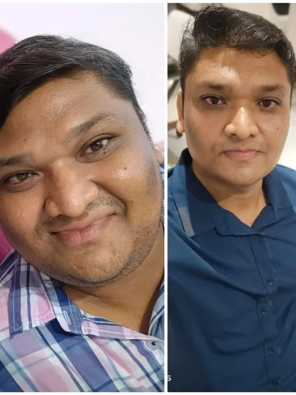 Dr. Kapil's transformation from 106 kg to 82 kg. This before-and-after shot shows the significant change in his face and overall health.