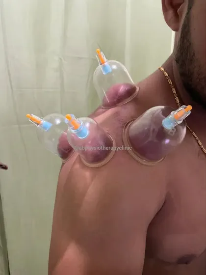 This patient is receiving cupping therapy for post-workout shoulder stiffness. Incorrect weightlifting form can lead to micro-injuries, and this treatment helps by increasing blood flow to the stressed joint and muscles, aiding in faster, more effective recovery.
