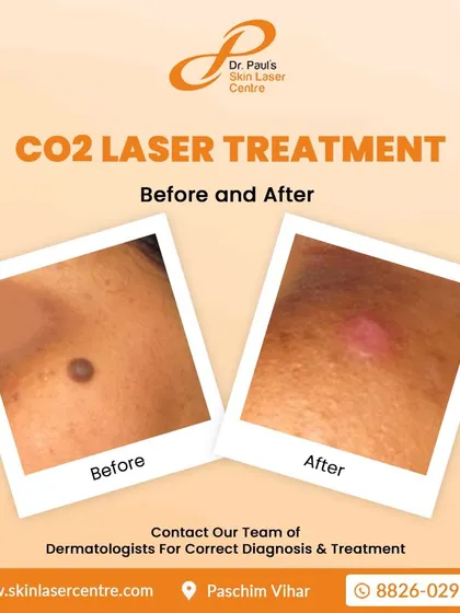 This is another example of a CO2 laser treatment for mole removal. The 'after' photo shows the area immediately post procedure, which then heals to reveal clear skin.