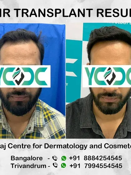 A frontal comparison showcasing the life-changing results of FUE surgery, restoring hair to areas of significant thinning.