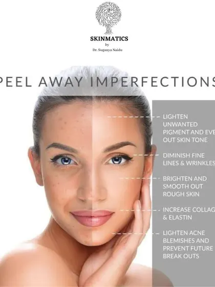 Chemical peels are a versatile and effective way to address multiple skin imperfections. They can lighten pigment, diminish fine lines, smooth rough texture, and help prevent future acne breakouts.