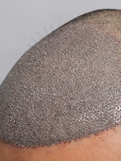 The start of a journey for a Diffuse Grade 4A patient. 3500 grafts were used to recreate the hairline, frontal zone, and mid-scalp.