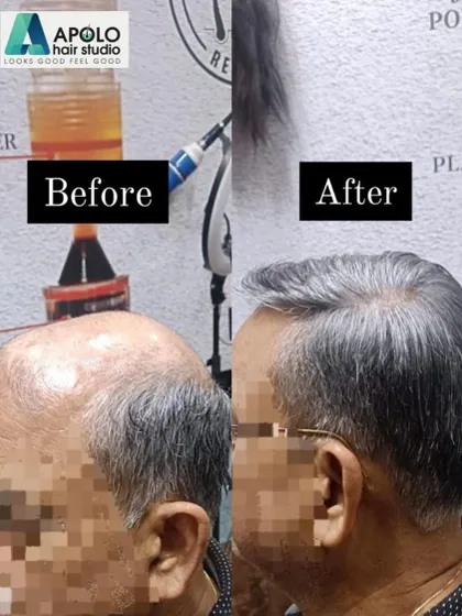 A fantastic result for a client with grey hair. Our custom hair patch seamlessly blends with his natural salt-and-pepper hair, covering the bald crown area and creating a very natural and age-appropriate style.