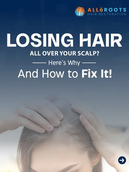 If you are noticing diffuse hair loss, where hair is thinning all over your scalp, it is often due to a condition called Telogen Effluvium. This is typically triggered by factors like stress, illness, or nutritional gaps.