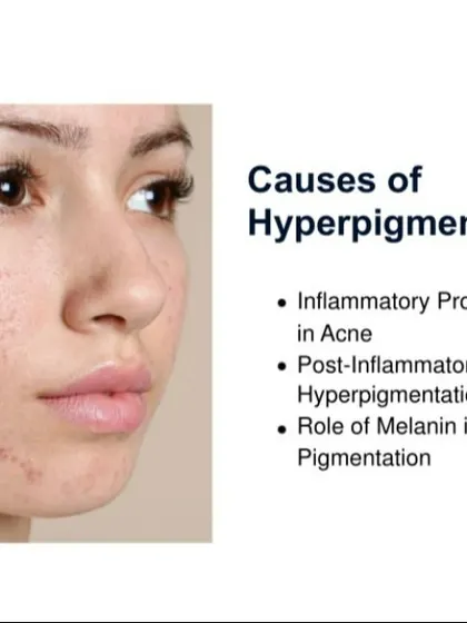 This graphic explains that hyperpigmentation in acne is often post-inflammatory (PIH). I treat this by first controlling the acne and then using specific agents like retinoids, vitamin C, or gentle peels to fade the dark marks left behind.