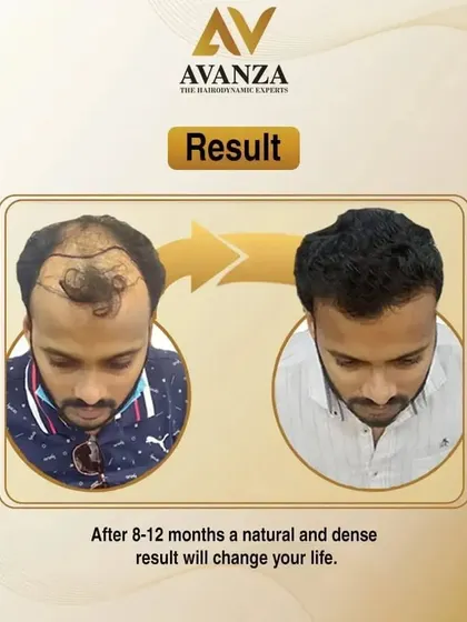 After 8-12 months, a natural and dense result can change your life. This image perfectly illustrates the journey from balding to a full head of hair.
