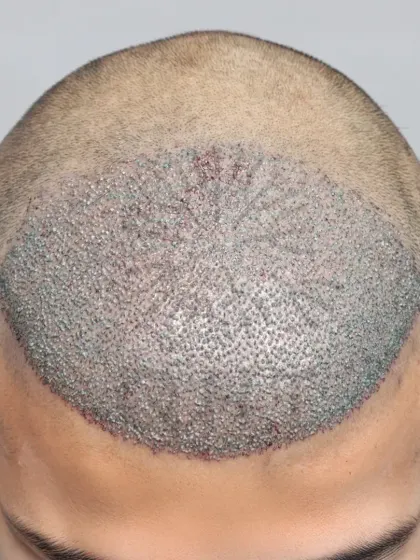 A high-density transformation in progress. 4000 grafts were implanted to rebuild the hairline and cover the mid-scalp.