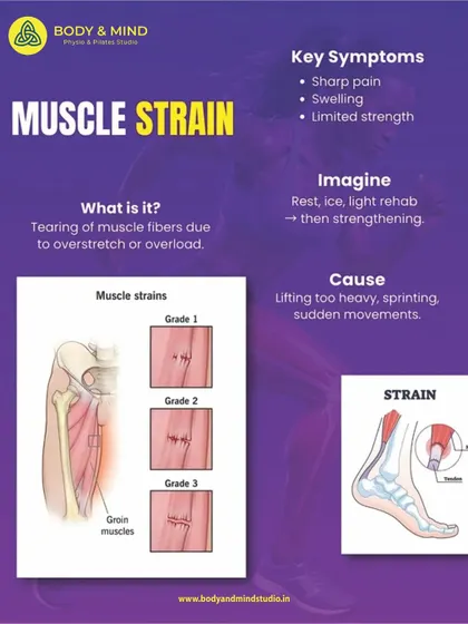 A muscle strain is the tearing of muscle fibers due to overstretching or overload, resulting in sharp pain and limited strength.