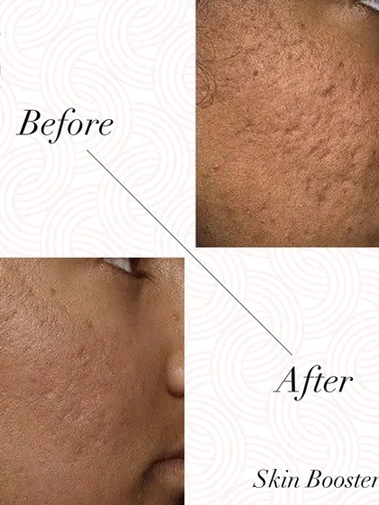 This before and after shows how Skin Boosters can significantly improve the appearance of acne scars by hydrating and plumping the skin.