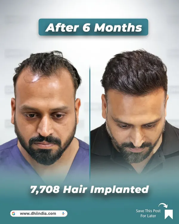 This is the result of our DHI Direct Hair Implantation technique just 6 months after the procedure. We implanted 7,708 hairs to restore this client's frontal hairline and density, creating a natural look that brings back confidence.