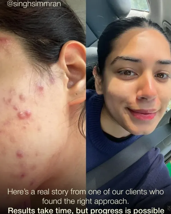 This patient struggled with inflammatory acne. Our customized plan focused on reducing breakouts and healing the skin, leading to this significant transformation and a boost in confidence.