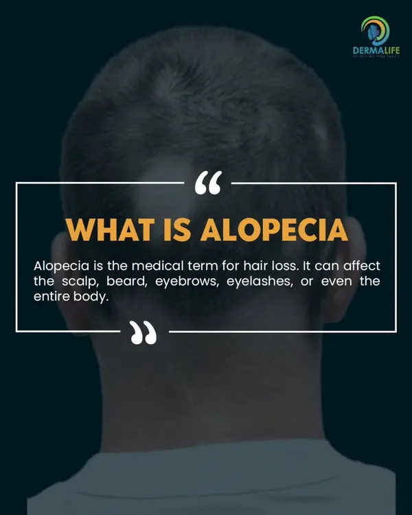 September is Alopecia Awareness Month. This post defines Alopecia, which is the medical term for hair loss and can affect any part of the body.