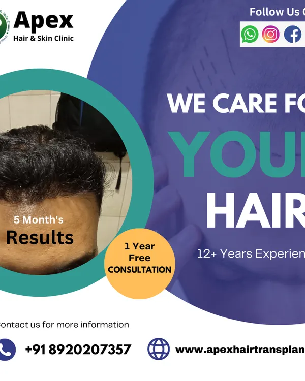 See the kind of results you can expect just five months after your procedure. We offer a free one-year consultation to monitor your progress and ensure you are completely satisfied with your hair restoration journey.