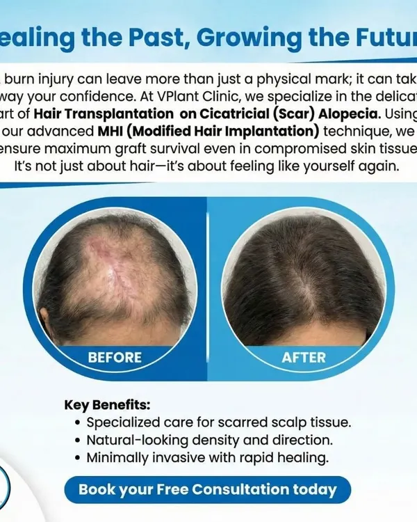 We specialize in complex cases, including hair transplantation on scar tissue (Cicatricial Alopecia). This before-and-after result shows how our advanced MHI technique can successfully restore hair even on skin compromised by a burn injury.