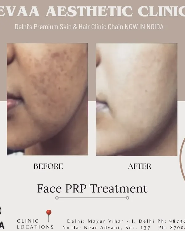 A striking before-and-after of a Face PRP Treatment, demonstrating significant improvement in skin texture and reduction of pigmentation and acne scars.