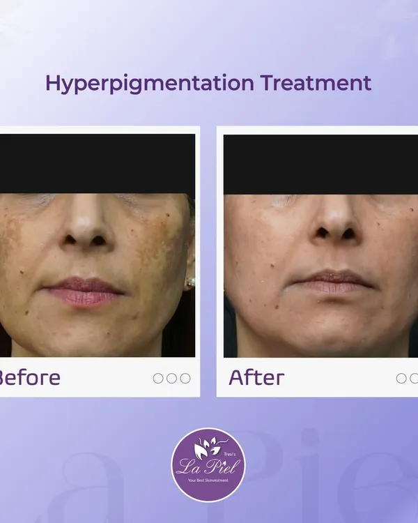 This before-and-after result demonstrates the effectiveness of a targeted hyperpigmentation treatment. By carefully addressing the affected areas, I was able to significantly lighten dark spots and restore a more uniform skin tone for my patient.