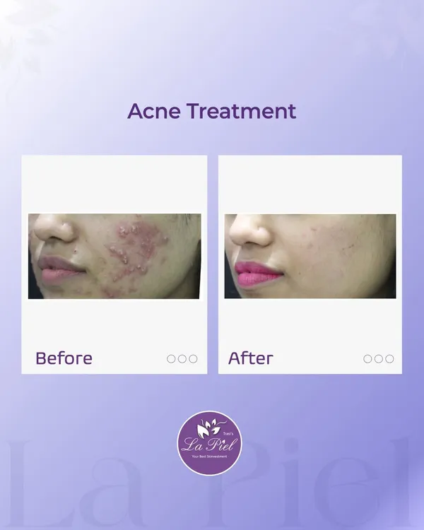 My approach to acne is to look beyond the surface to find and treat the root cause. This before-and-after image shows the result of a personalized acne treatment plan, which not only cleared active breakouts but also improved skin texture for a healthier, more confident appearance.