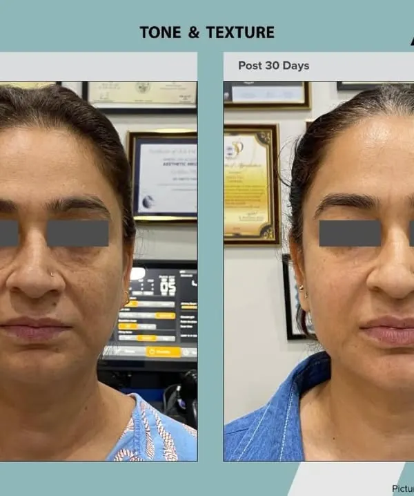 This is a direct look at the skin rejuvenation possible with our exclusive ADVA Tx laser. After just 30 days, you can see a significant improvement in skin tone, texture, and overall radiance, all achieved with zero downtime.