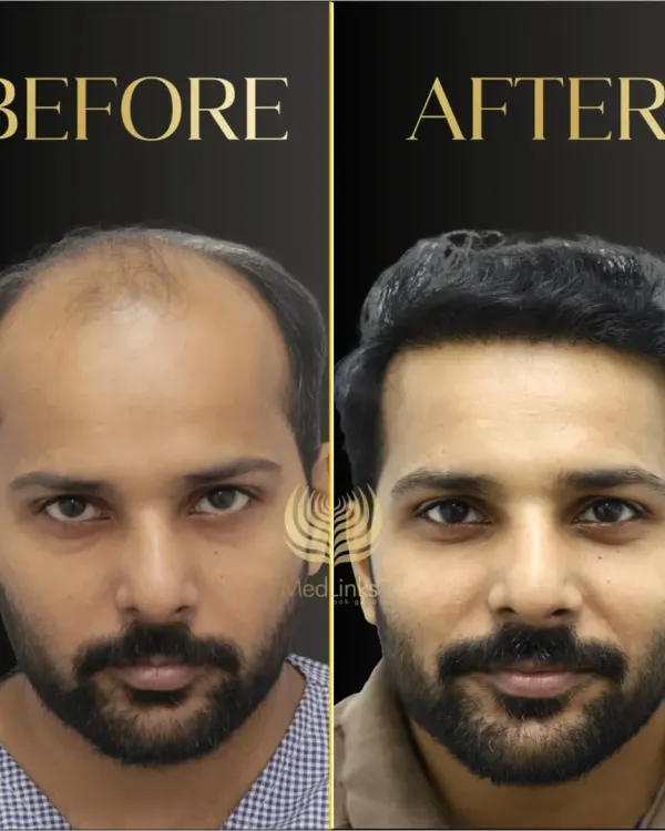 This is what a life-changing transformation looks like. We don't just restore hair; we restore the confidence that comes with it. Using our advanced Perfect-i FUE technique, we create hairlines that are dense, natural, and perfectly suited to your face.
