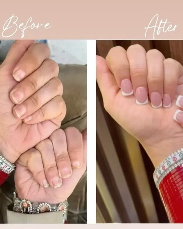 A classic transformation. This before and after shot shows how we create a clean and elegant look with classic French tip nail extensions on short, square-shaped nails.